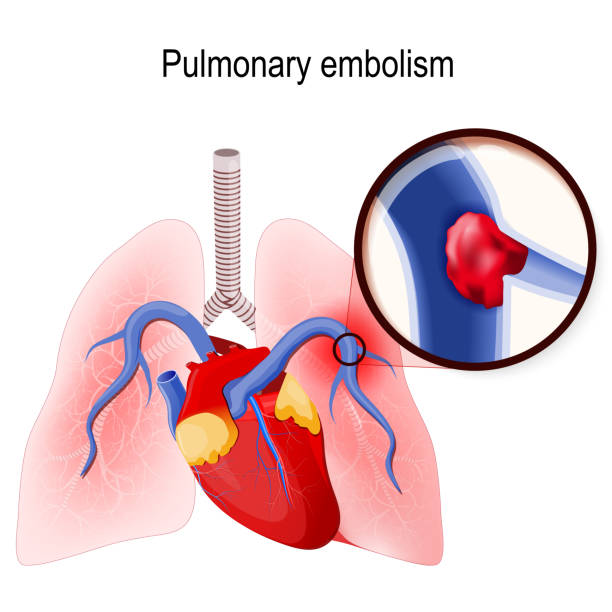 illustrazioni stock, clip art, cartoni animati e icone di tendenza di embolia polmonare. - cross section illustrations