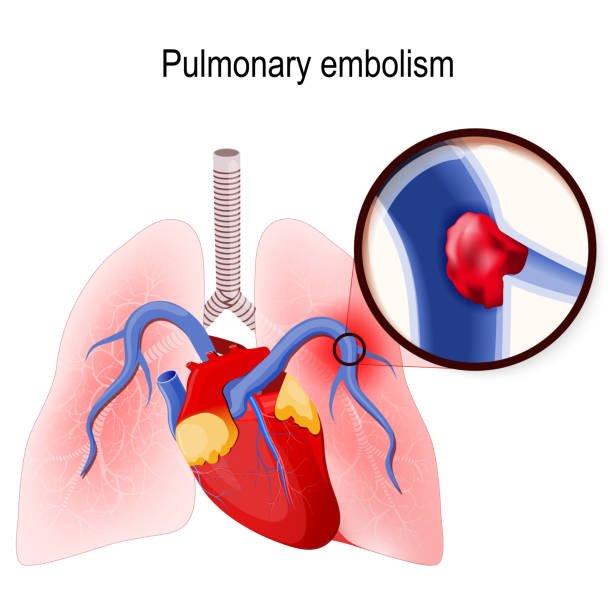 ilustrações de stock, clip art, desenhos animados e ícones de pulmonary embolism. - cross section illustrations