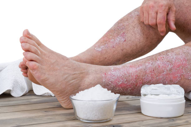 Psoriasis skin lesions stock photo