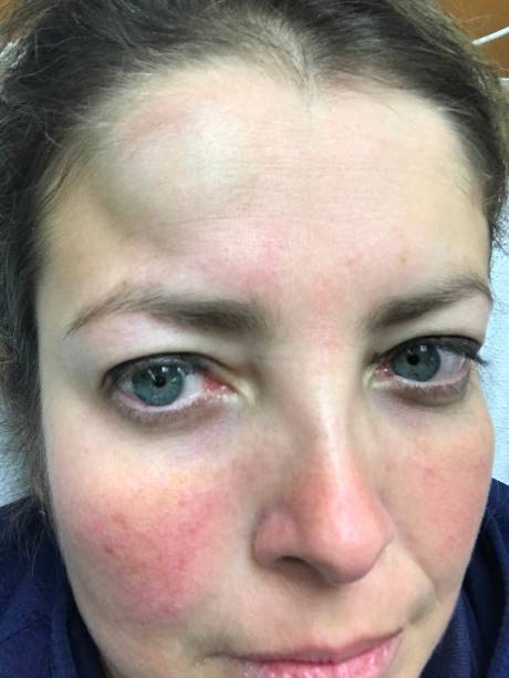 istock Young Woman with Head Bump Injury 910884312