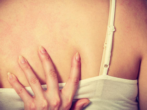 istock woman scratching her itchy back with allergy rash 911185592