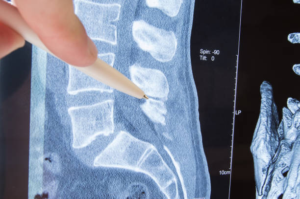 foto mri lumbosakralen wirbelsäule pathologie. radiologe angegeben auf möglichen pathologie oder krankheit des bild der lumbosakralen wirbelsäule mri wie ischias, vorwölbung der scheibe, eingeklemmter nerv, hernie, stenose - operative stock-fotos und bilder