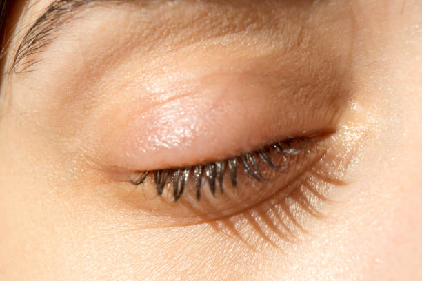 istock Barley infection on the eye 911522546