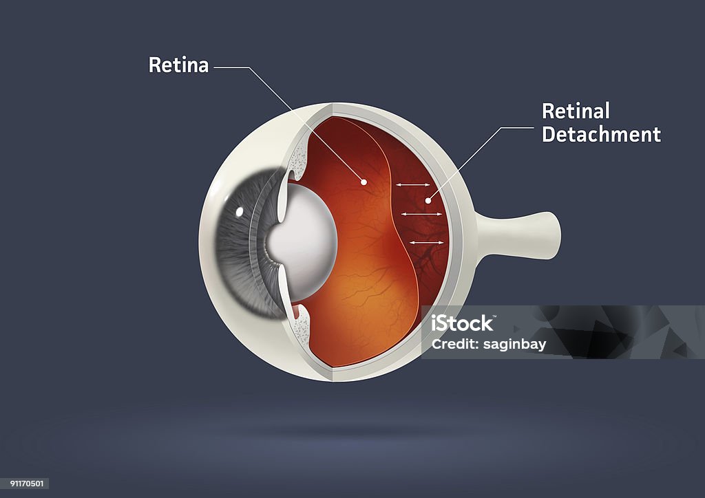 Retinal detachment  Retina Stock Photo