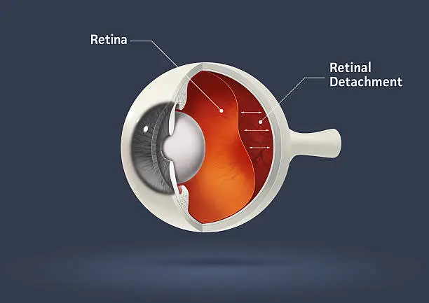 Photo of Retinal detachment