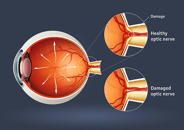 High quality raster illustration of retinal detachment with clipping path.