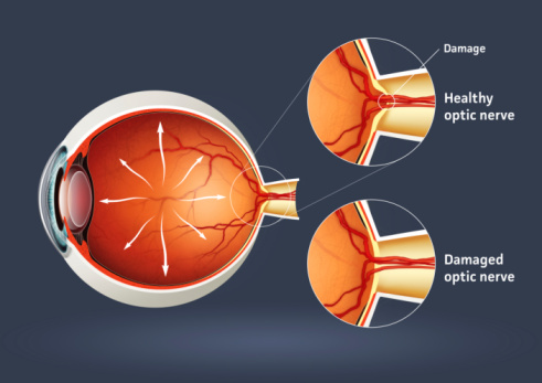 High quality raster illustration of retinal detachment with clipping path.