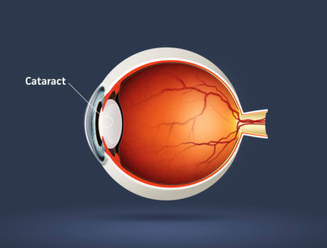 Light beam is shining through retina and lens on eyesight exam