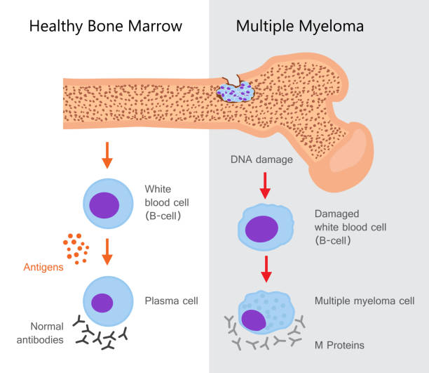 bildbanksillustrationer, clip art samt tecknat material och ikoner med multipelt myelom diagram - amyloid