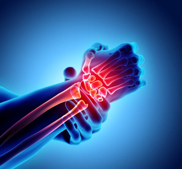 istock Wrist painful - skeleton x-ray. 912268026