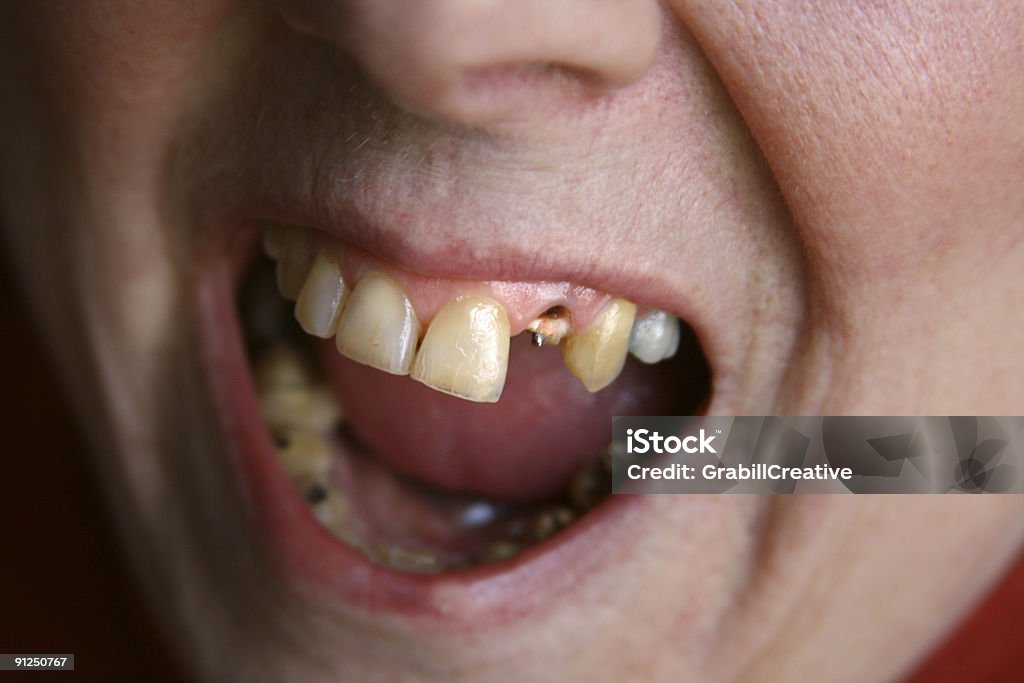 Ahhh! Open Wide for the Dentist! Woman Missing Tooth  Adult Stock Photo