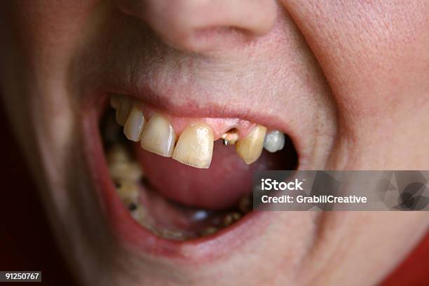 Ahhh Open Wide For The Dentist Woman Missing Tooth Stock Photo - Download Image Now