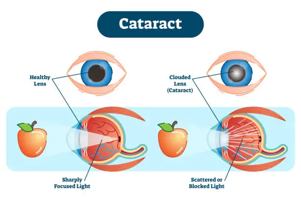 Vector illustration of Cataract vector illustration diagram, anatomical scheme.