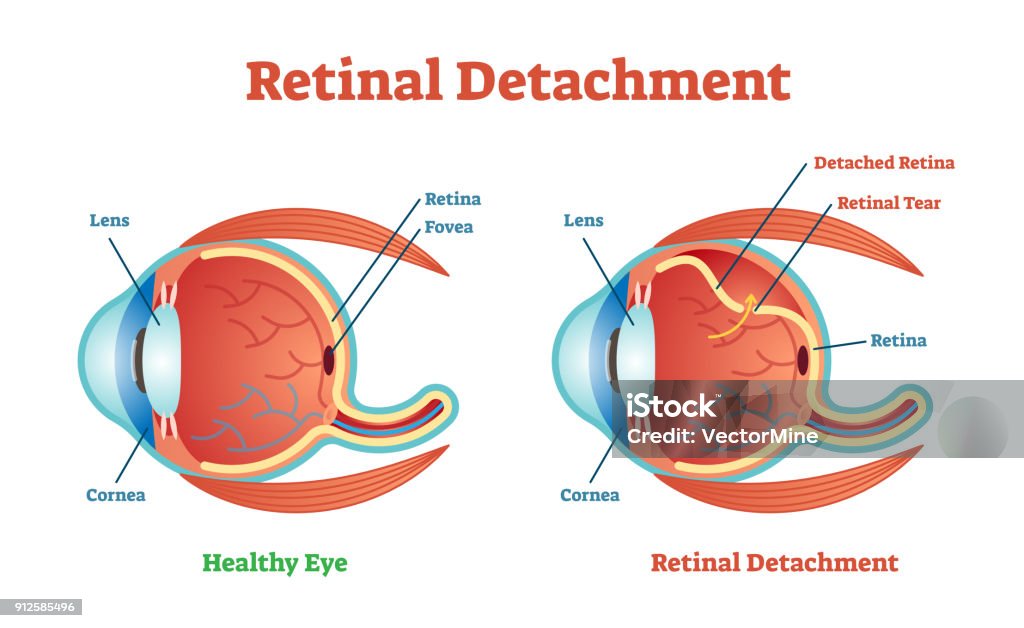 Retinal Detachment vector illustration diagram, anatomical scheme. Retinal Detachment vector illustration diagram, anatomical scheme. Medicinal educational information. Retina stock vector