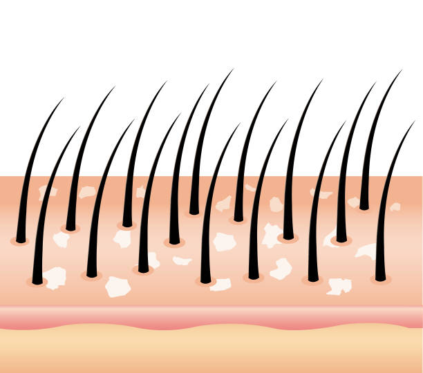 Dandruff on hair (vector),hair scalp. Dandruff on hair (vector),hair scalp. Fungus on the scalp.Cause of hair loss. Allergic to toxins. Disorders of the scalp. dandruff stock illustrations