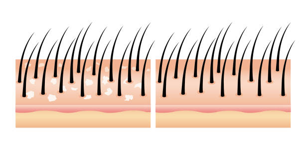 ilustrações de stock, clip art, desenhos animados e ícones de dandruff on hair before and after (vector),hair scalp. - friable