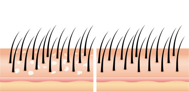łupież na włosach przed i po (wektor), włosy głowy. - friable stock illustrations