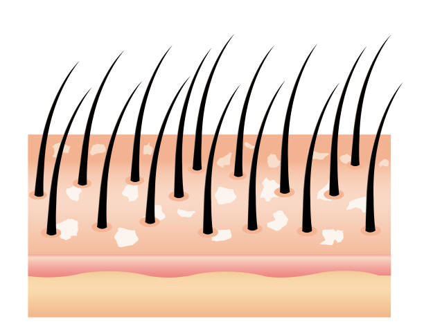 ilustrações de stock, clip art, desenhos animados e ícones de dandruff on hair (vector),hair scalp. - friable