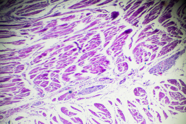 istock Carcinoma of oesophagus (well differentiated squamous disease) 912829906
