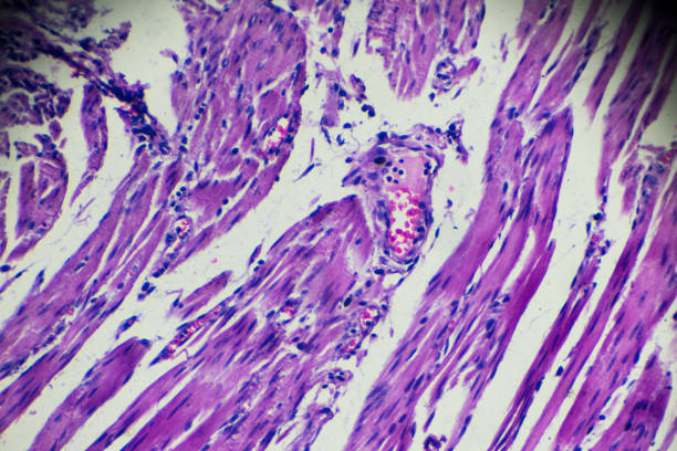 istock Carcinoma of oesophagus (well differentiated squamous disease) 912830150