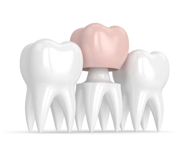 istock 3d render of teeth with dental crown restoration 912858236