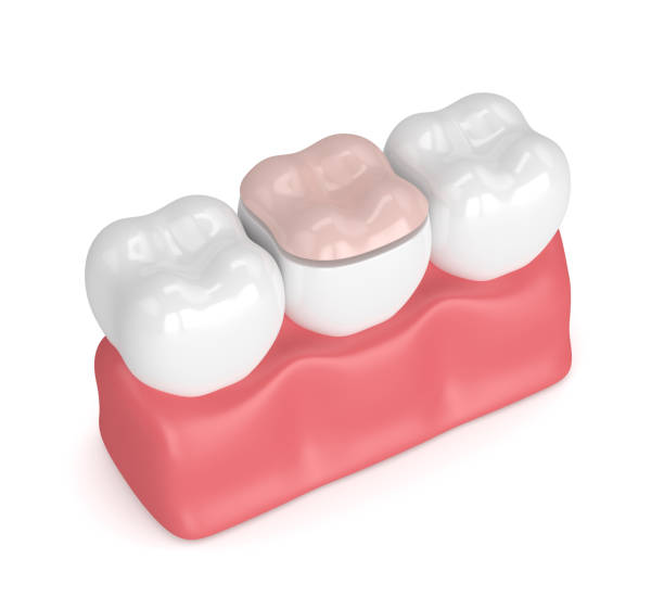 rendu 3d des dents avec remplissage onlay dentaire - inlaid photos et images de collection