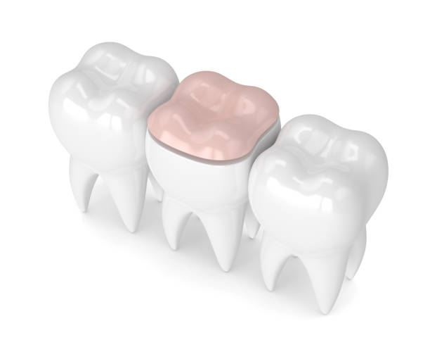 istock 3d render of teeth with dental onlay filling 912863750