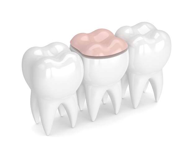 istock 3d render of teeth with dental onlay filling 912863966
