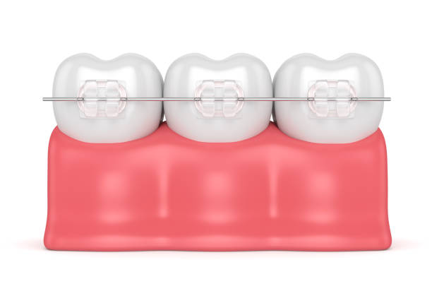 istock 3d render of teeth with ceramic clear braces 912871316