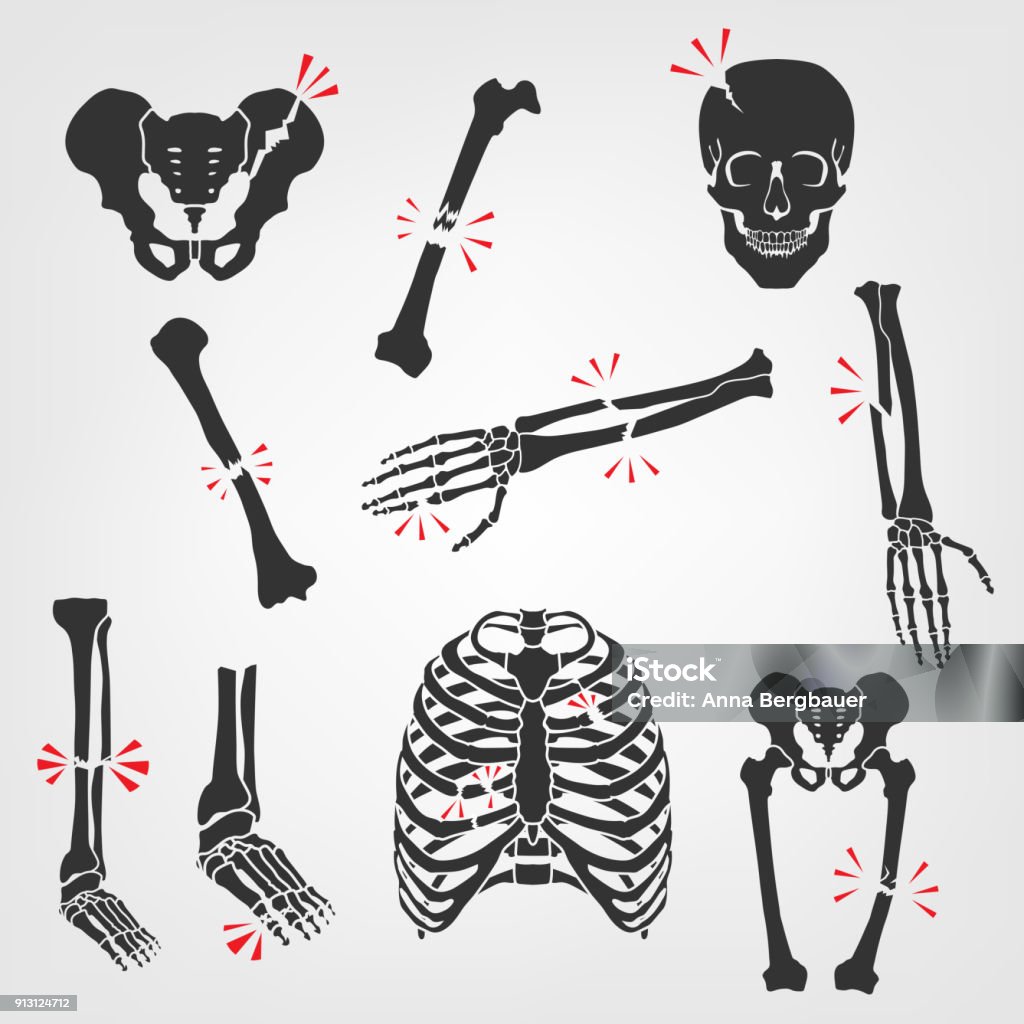 Bones Fractures Icons Bones Fractures Icons. Flat vector illustrations isolated on a white background. Broken skull, ribs, thigh, foot, pelvis, femur, hand palm, etc Bone stock vector