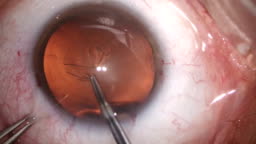 Cataract Eye Surgery Stock Video - Download Video Clip Now - Surgery, Eye,  Cataract - iStock