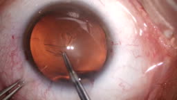 Cataract Eye Surgery Stock Video - Download Video Clip Now - Surgery, Eye, Cataract - iStock Cataract Eye Surgery Stock Video - Download Video Clip Now - Surgery, Eye, Cataract - iStock