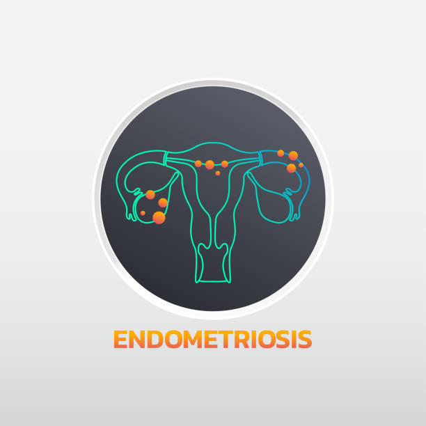 Endometriosis icon design, infographic health. Vector illustration. vector art illustration