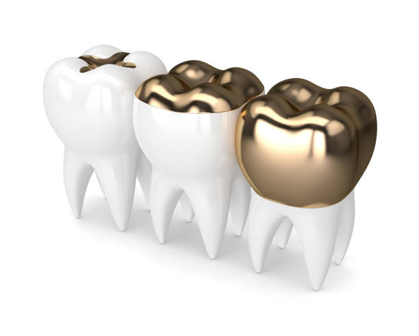 istock 3d render of teeth with dental gold fillings 913634540