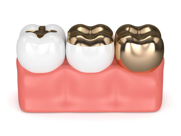 istock 3d render of teeth with dental gold fillings 913634694