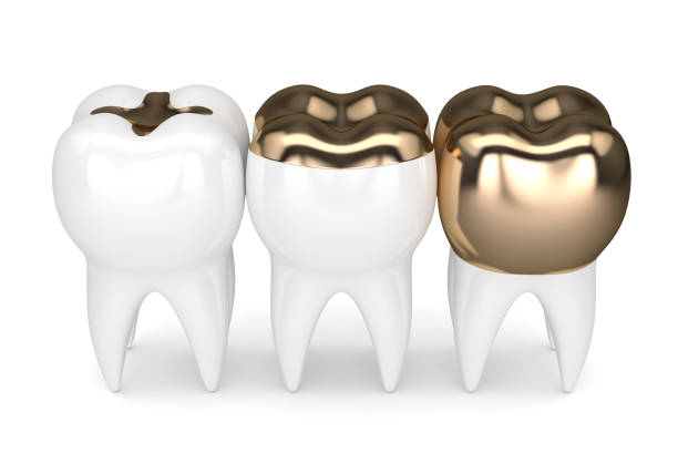 istock 3d render of teeth with dental gold fillings 913637292