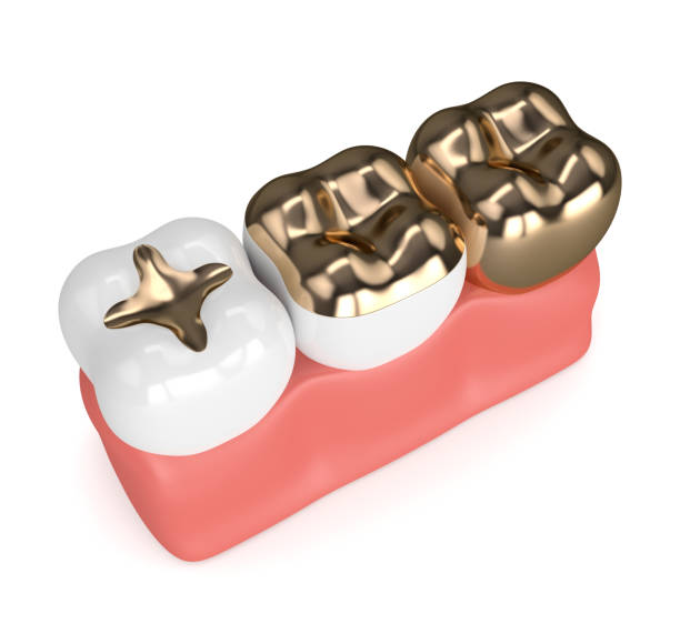 istock 3d render of teeth with dental gold fillings 913637504