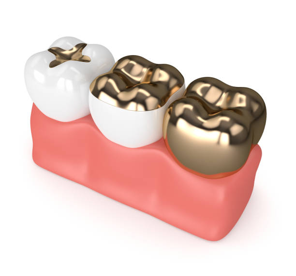 istock 3d render of teeth with dental gold fillings 913638014