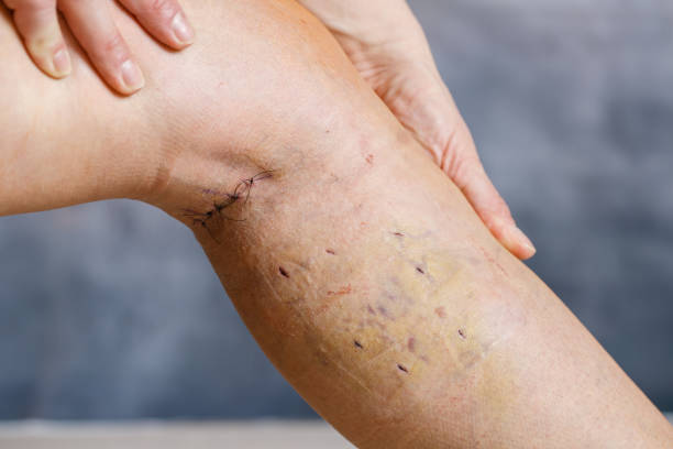Womans leg after phlebectomy Womans leg after varicose vein surgery, with visible surgical sutures (stitches) and wounds on her leg. Curative treatment, aesthetic procedures, thrombosis prevention and senior health care concept. blood clot photos stock pictures, royalty-free photos & images
