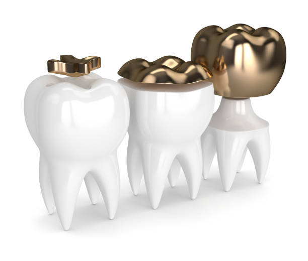 istock 3d render of teeth with dental gold fillings 913835156