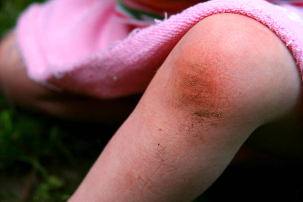 istock Child's Knee Scuffed Red and Dirty from crawling: Crawler 91383857