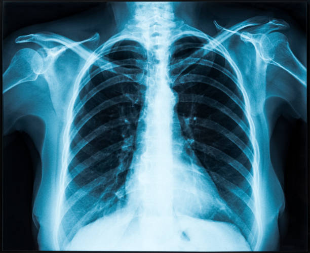 X-ray of thorax Woman thorax x-ray for lungs examination chest torso stock pictures, royalty-free photos & images