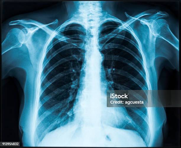 Xray Of Thorax Stock Photo - Download Image Now - X-ray Image, Medical X-ray, Chest - Torso