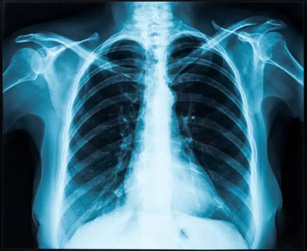 Woman thorax x-ray for lungs examination