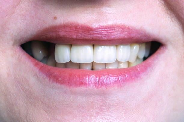 mouth with four prosthetic upper teeth - toothless grin imagens e fotografias de stock