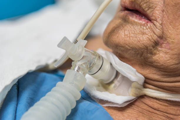 Patient do tracheostomy and ventilator in hospital stock photo