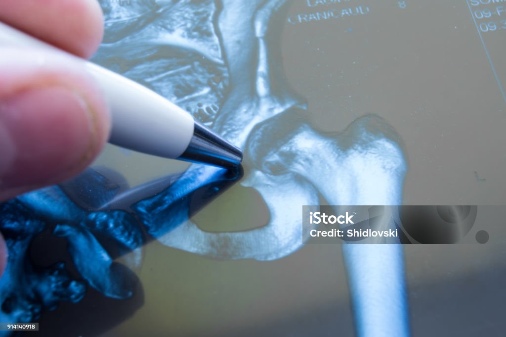 X-ray of hip joint. Doctor pointed on area of hip joint, where pathology is detected, such as fracture, destruction of joint, coxarthrosis, osteoarthritis. Diagnosis of joint diseases by radiology Hip - Body Part Stock Photo