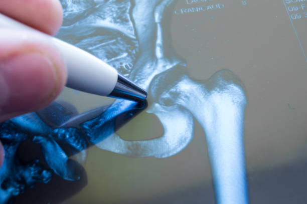 X-ray of hip joint. Doctor pointed on area of hip joint, where pathology is detected, such as fracture, destruction of joint, coxarthrosis, osteoarthritis. Diagnosis of joint diseases by radiology X-ray of hip joint. Doctor pointed on area of hip joint, where pathology is detected, such as fracture, destruction of joint, coxarthrosis, osteoarthritis. Diagnosis of joint diseases by radiology bone fracture stock pictures, royalty-free photos & images