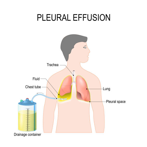 Pleural effusion. Treatment of tension hydrothorax Pleural effusion. Diagram showing human silhouette with highlighted lungs, fluid buildup in the pleura, Chest Tube, and Drainage container. Treatment of tension hydrothorax (or hemothorax) insertion of chest tubes for invasive procedure to remove fluid chest stock illustrations