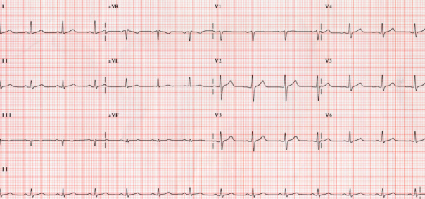 An abnormal ECG trace graph showing heart blocks with a stethoscope